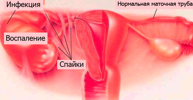 Спайки в малом тазу, гнойный сальпингоофорит